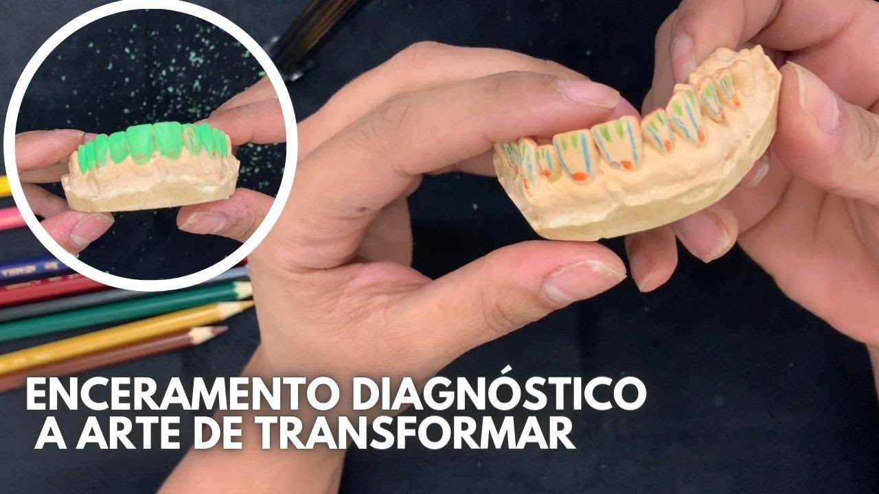 Enceramento Diagnóstico - Passo a Passo