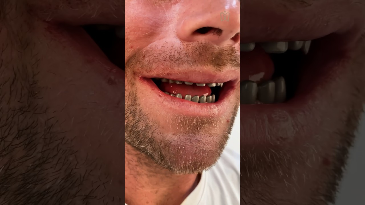 Shocking change comes with a great transition #dental #shorts #porcelainveneers #hollywoodsmile