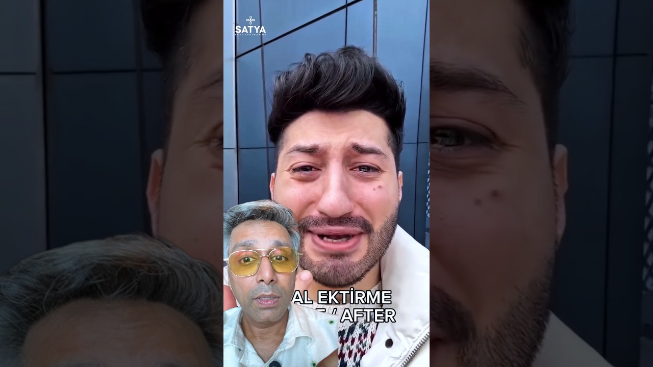 Beard Transplant Gone Wrong #hairtransplant #ytshorts #shortvideo #beard #hairloss #beardtransplant