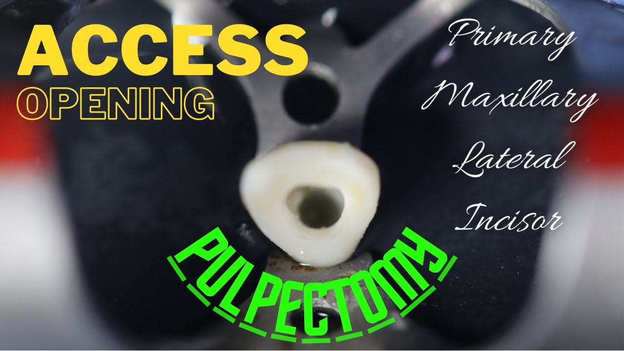Access Opening | pulpectomy | primary maxillary lateral incisor