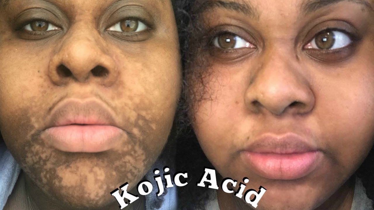 4 MONTHS KOJIC ACID EXPERIENCE \\ Sherelle Saint Rose