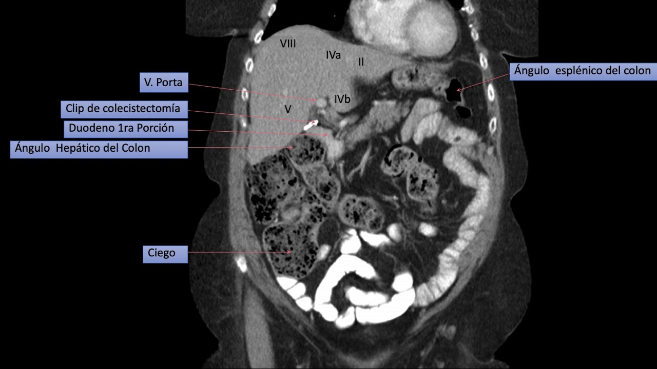 TOMOGRAFIA CORONAL BASICA DE ABDOMEN Y PELVIS