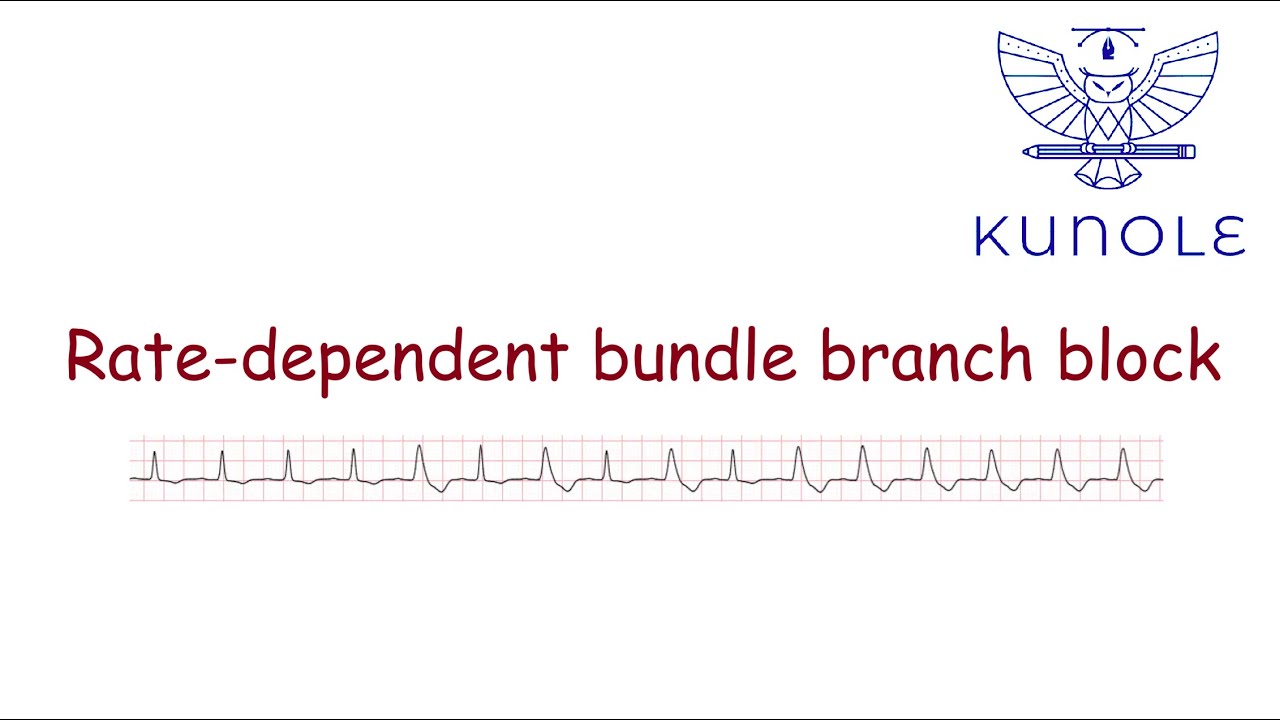 Bradycardias and conduction disorders (3.6). Rate-dependent bundle branch block