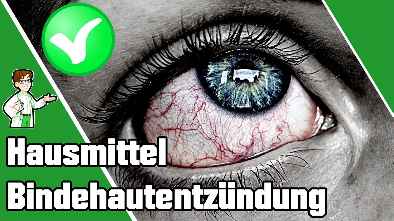 5 Hausmittel gegen Bindehautentzündung 👀