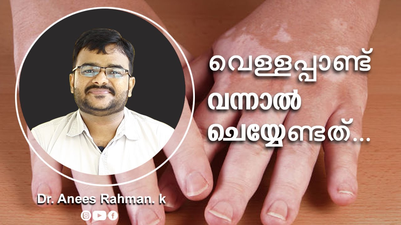 How to Treat Vitiligo? | വെള്ളപ്പാണ്ട് വന്നാൽ ചെയ്യേണ്ടത് | DR ANEES UNANI