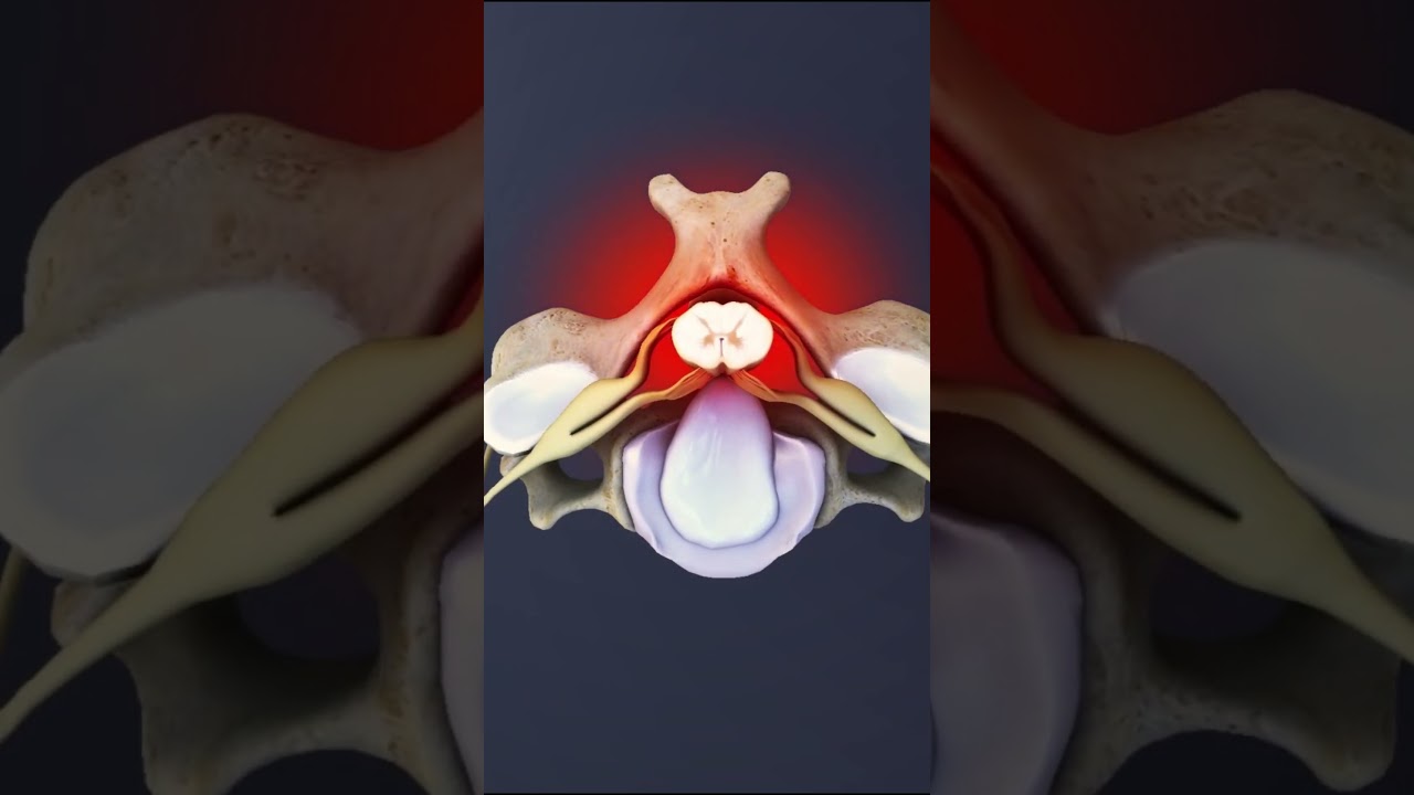 Compression of the Spinal Cord at the Cervical Level