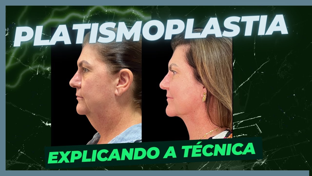 PLATISMOPLASTIA,  a técnica que elimina a papada!