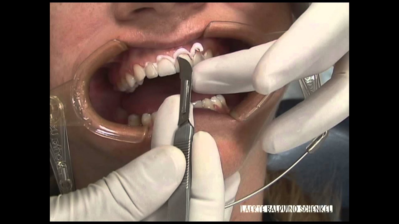 Veneer cementation