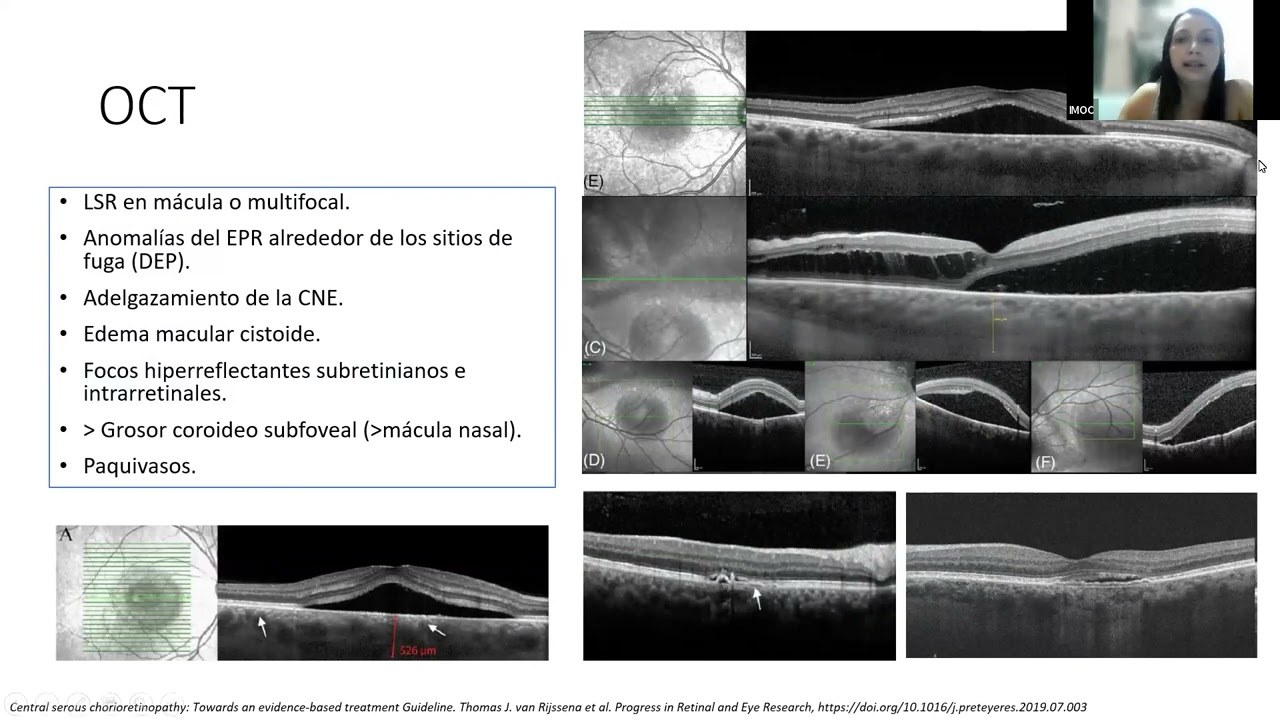 Coriorretinopatía Serosa Central - Dra Gusmary Hernández