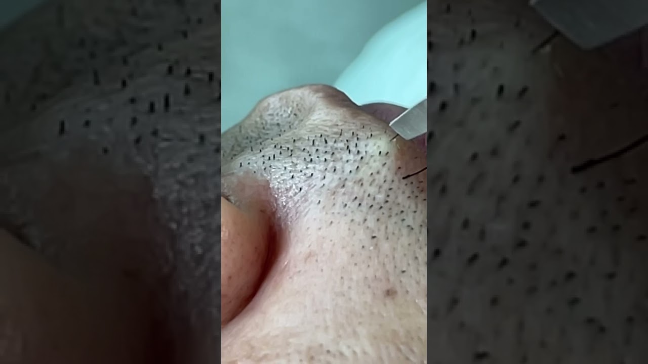 콧 수염 털 뽑기 슬로우