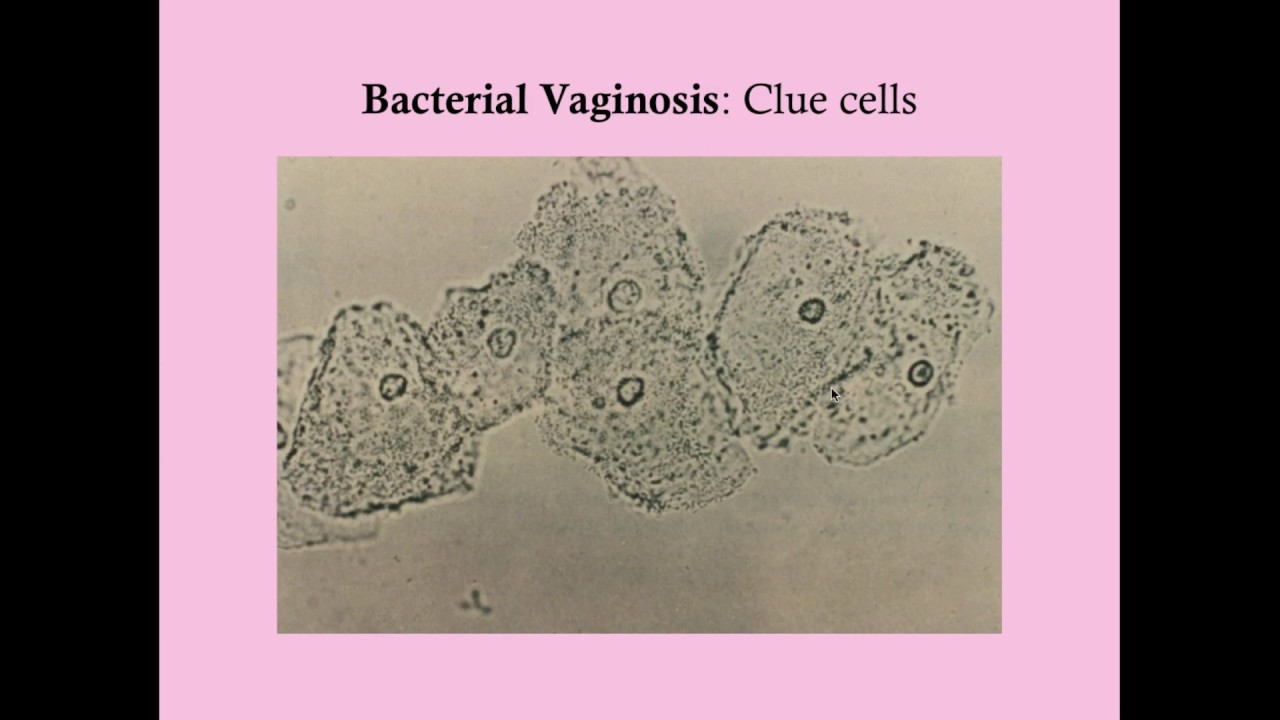 Bacterial Vaginosis in Pregnancy - CRASH! Medical Review Series