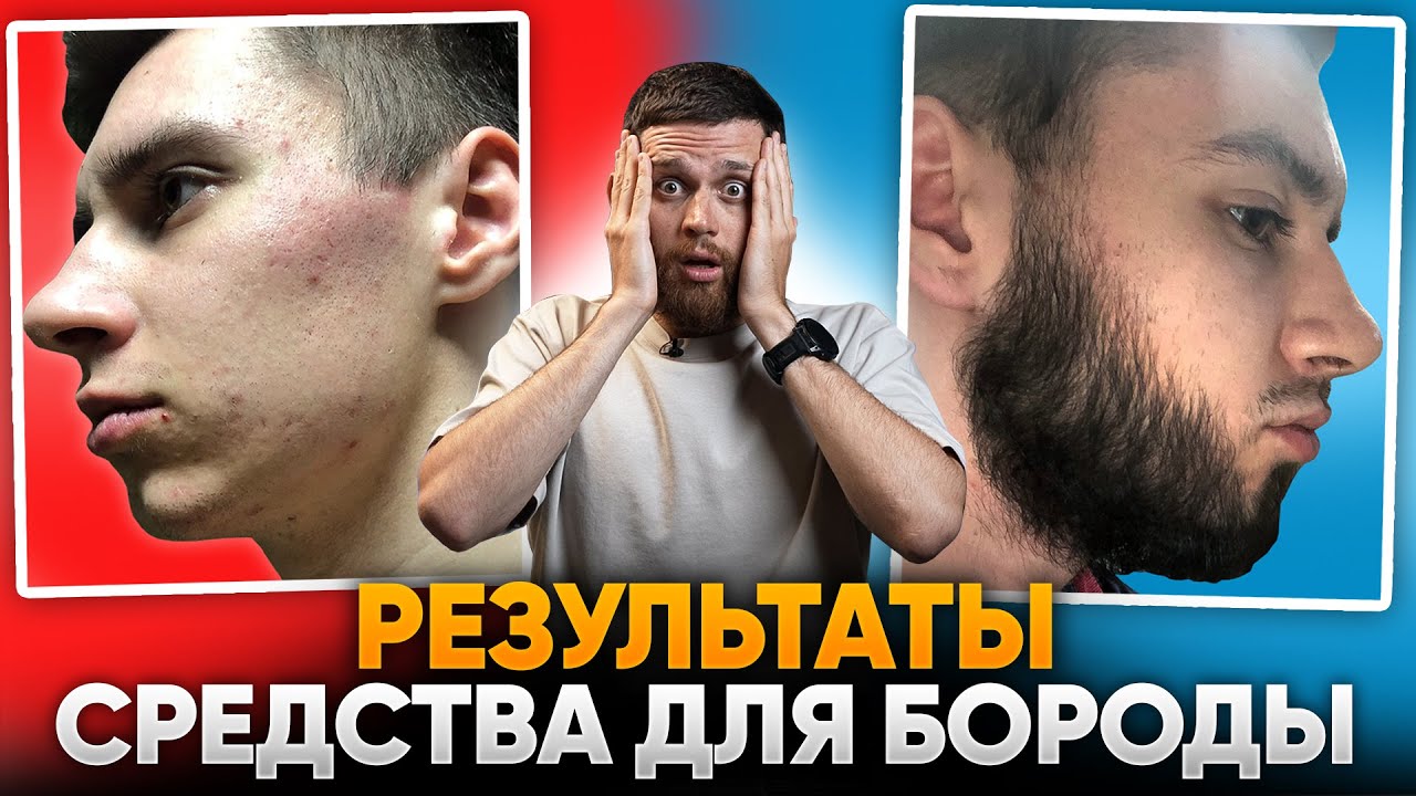В 21 ГОД НЕ РОСЛА БОРОДА / Отрастил бороду С НУЛЯ с помощью ксиноксина