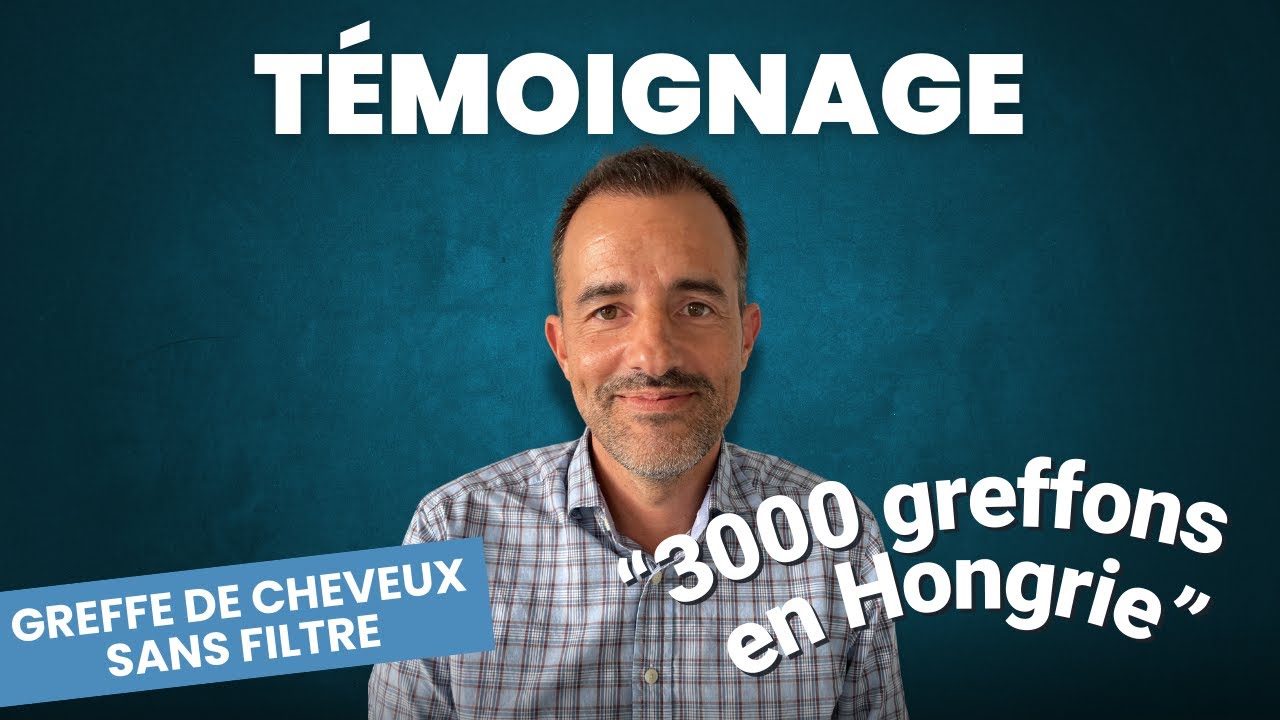 Greffe de cheveux 2 ans apr&egrave;s : C&eacute;dric t&eacute;moigne