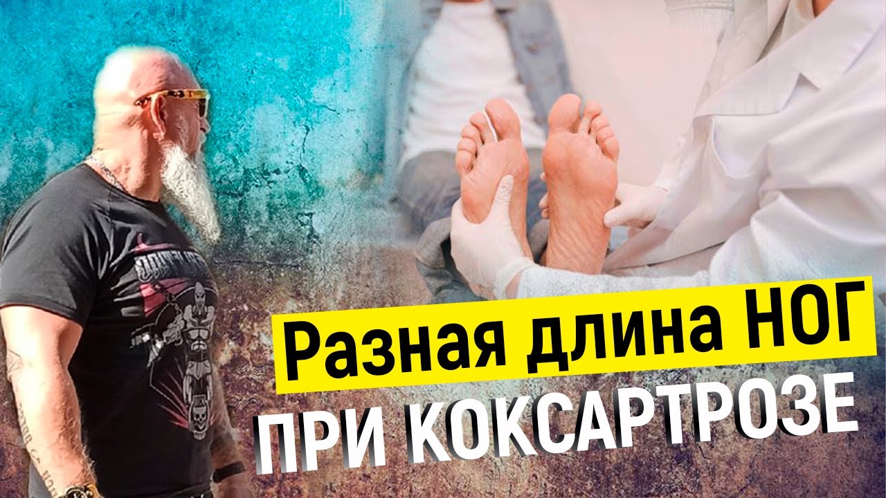РАЗНАЯ ДЛИНА НОГ при коксартрозе - ЧТО ДЕЛАТЬ? | ТРЕНЕР ХАПАЕВ