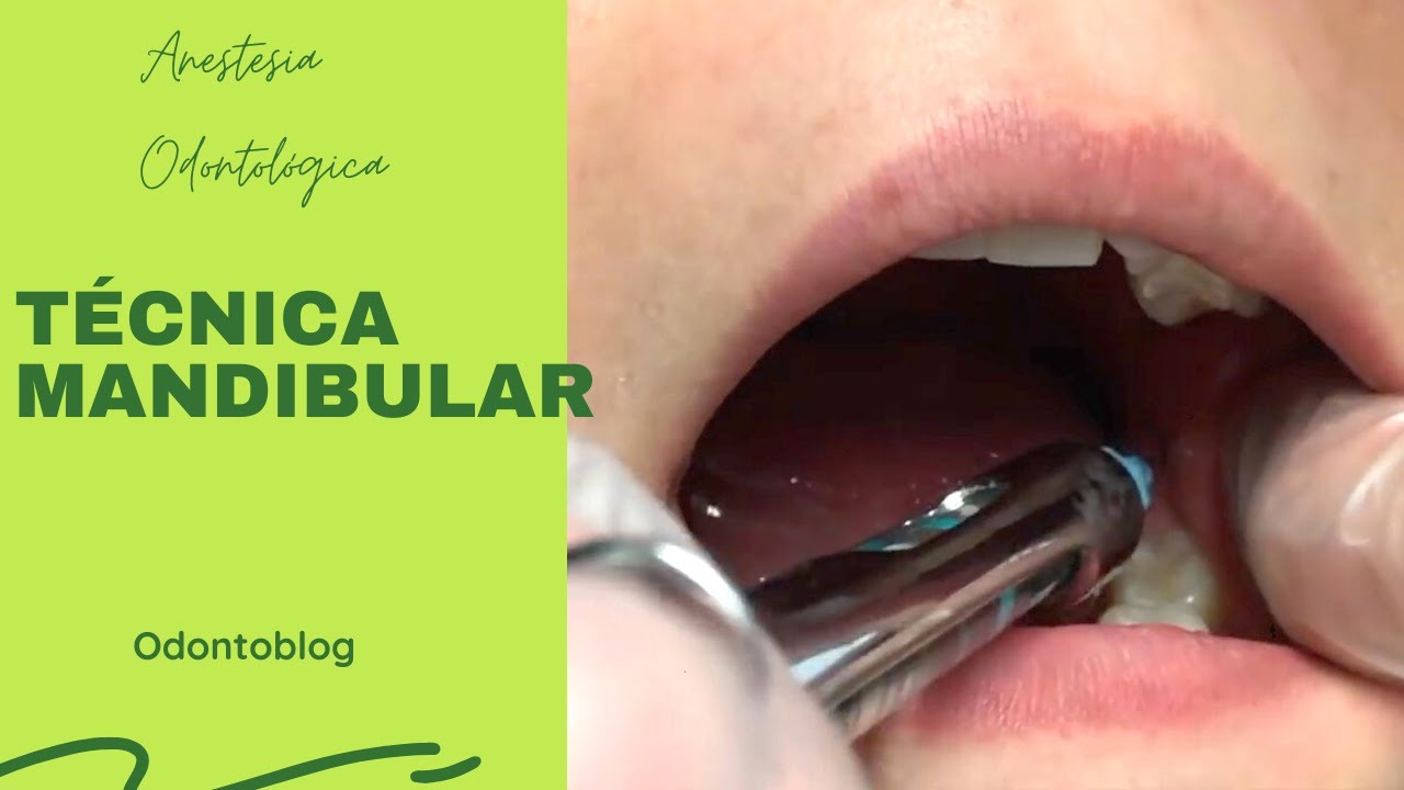 Técnica Mandibular