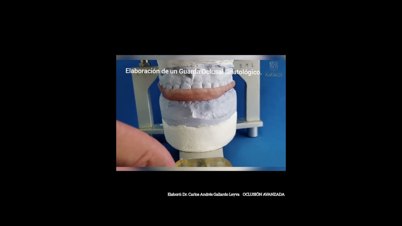 Elaboración de una guarda oclusal gnatológica.