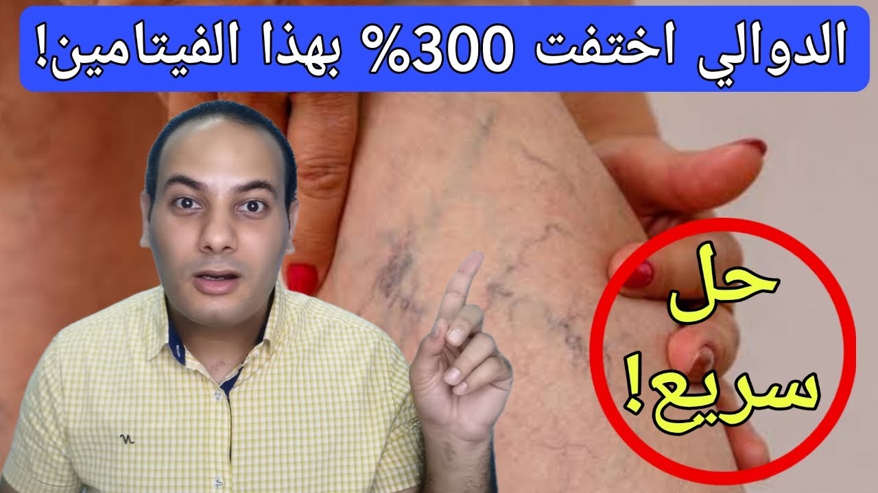 تناوله يوميا لعلاج دوالي الساقين نهائياً بنسبة 300 %/علاج الدوالي بدون جراحه / افضل فيتامين للدوالي!