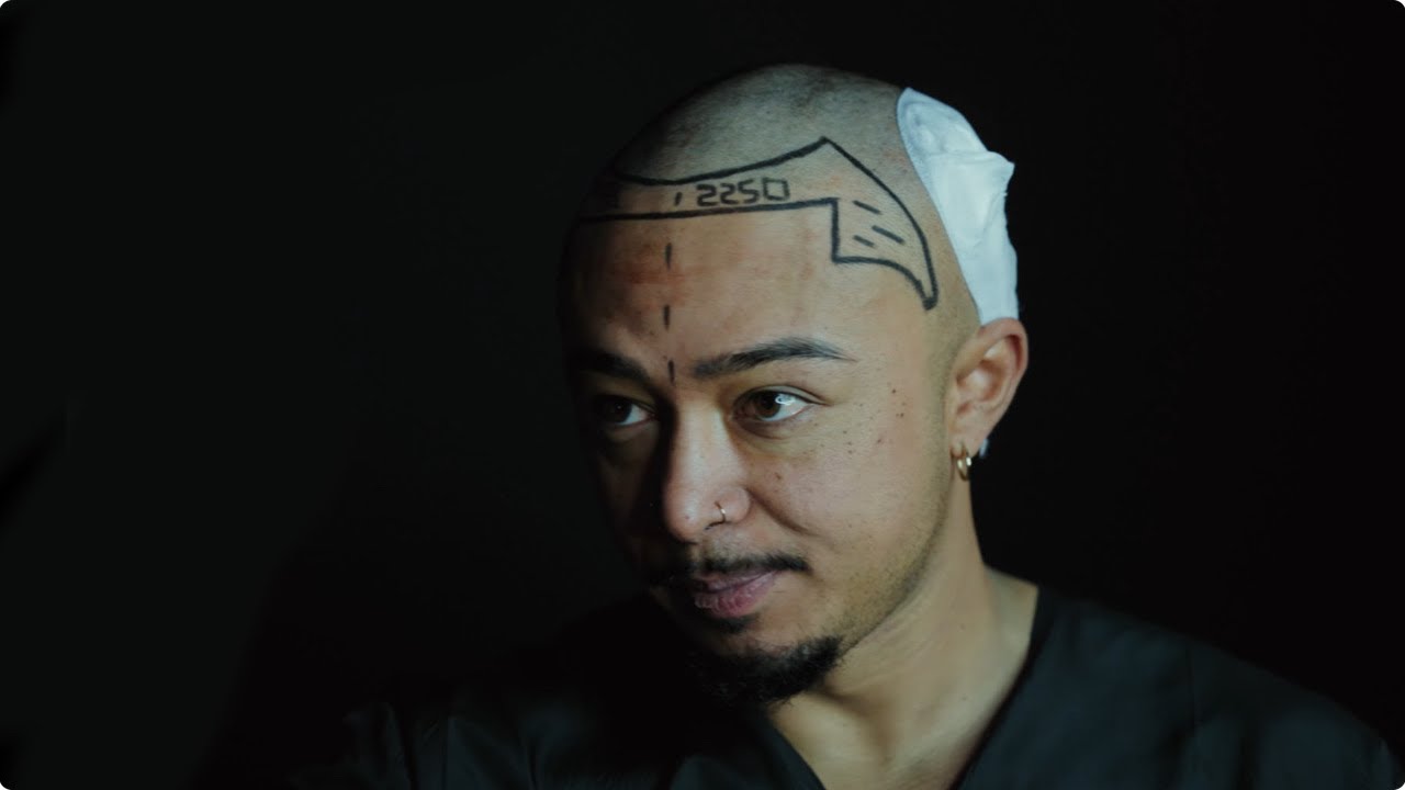 HAARTRANSPLANTATION in ISTANBUL || VLOG