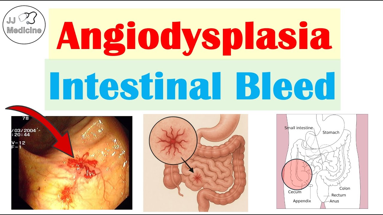 Angiodysplasia (Common Cause of Intestinal Bleeding) Causes, Signs & Symptoms, Diagnosis, Treatment