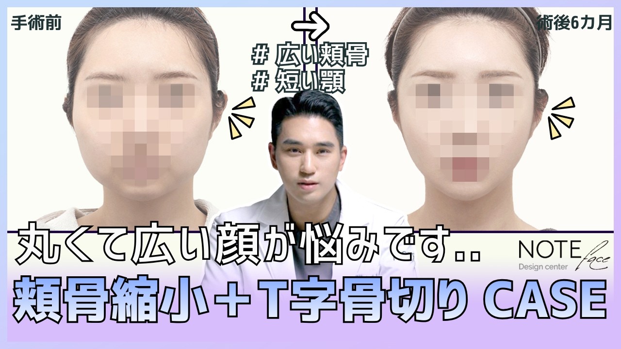 短すぎるアゴには○○！丸顔が卵型になる過程 🥚✨｜韓国整形｜輪郭整形
