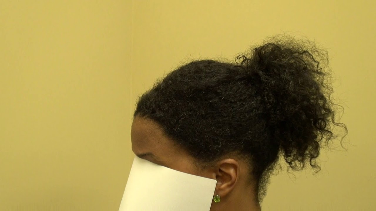 Black African American Woman Hair Restoration FUT Strip Method by Dr. Diep