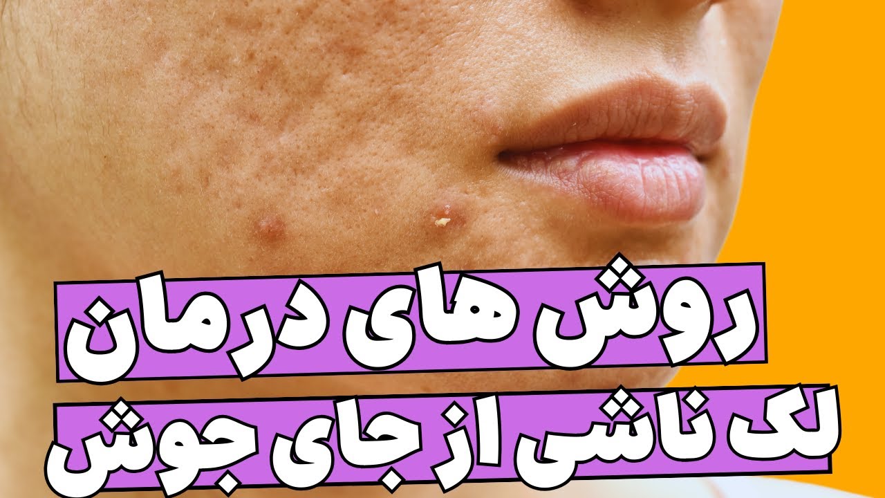 روشهای درمان لک ناشی از جای جوش