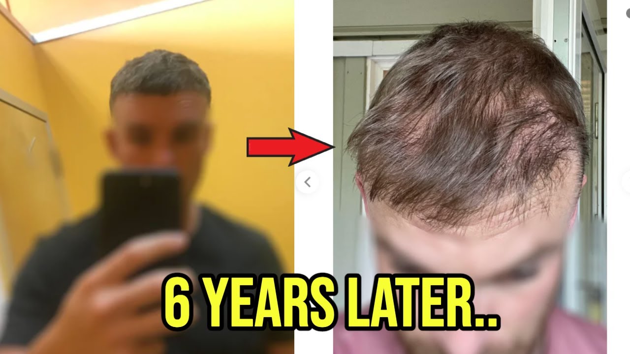 ПЕРЕСАДКА ВОЛОС БЕЗ ФИНАСТЕРИДА В ТЕЧЕНИЕ 6 ЛЕТ!! ВОТ ЧТО ПРОИЗОШЛО...