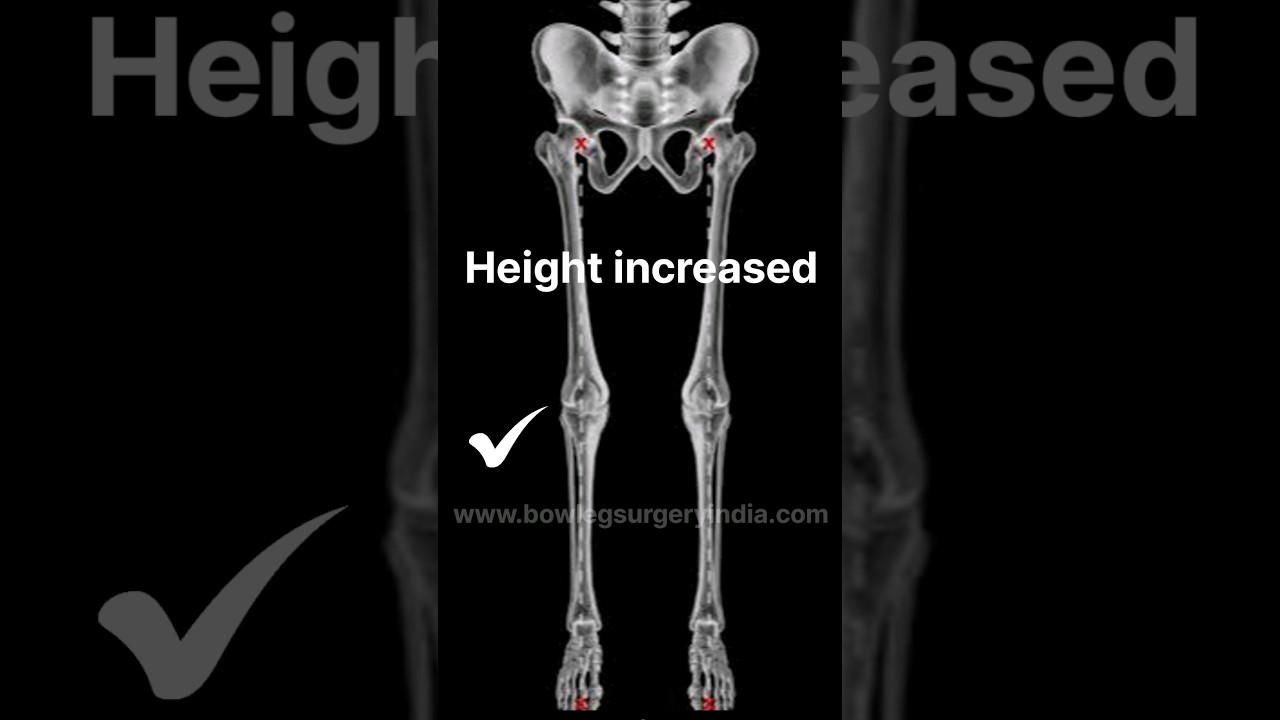 Bow legs to normal legs. #bowlegs #genuvarum