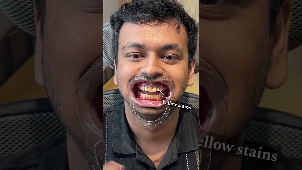 How Teeth Whitening Is Done with Perfora Purple Magic Serum | Purple Magic Test - Episode 1