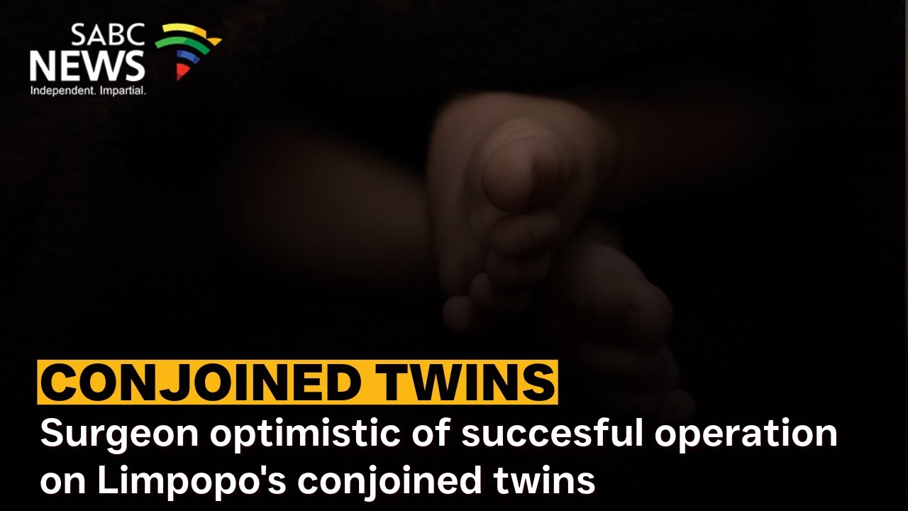 Surgeon optimistic of succesful operation on Limpopo's conjoined twins