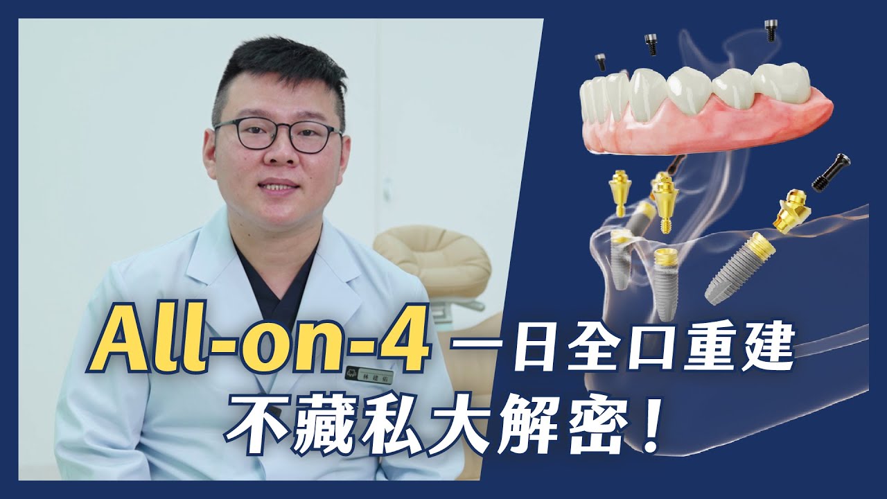 【All-on-4一日全口重建到底是什麼？全口缺牙一天就能完成～】MVP牙醫-林建佑醫師