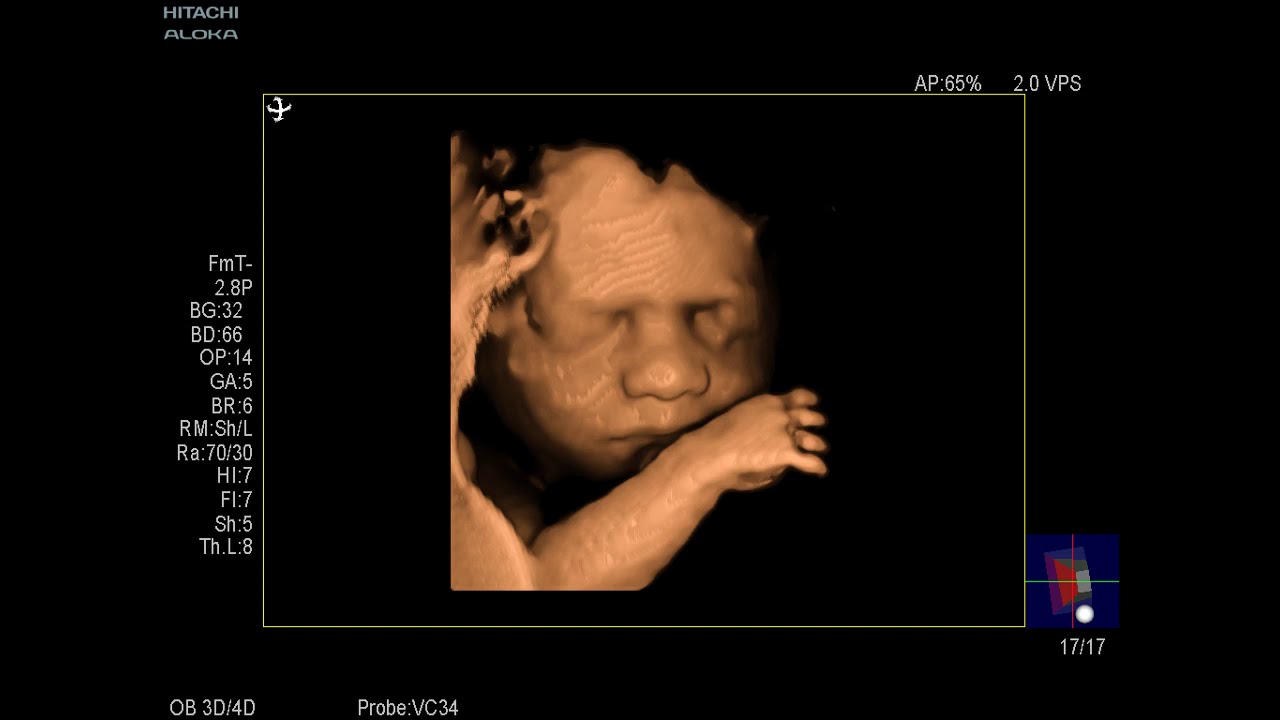 Dormed Hellas - ARIETTA 60 - Obstetrics 2D, Color and 4D mode