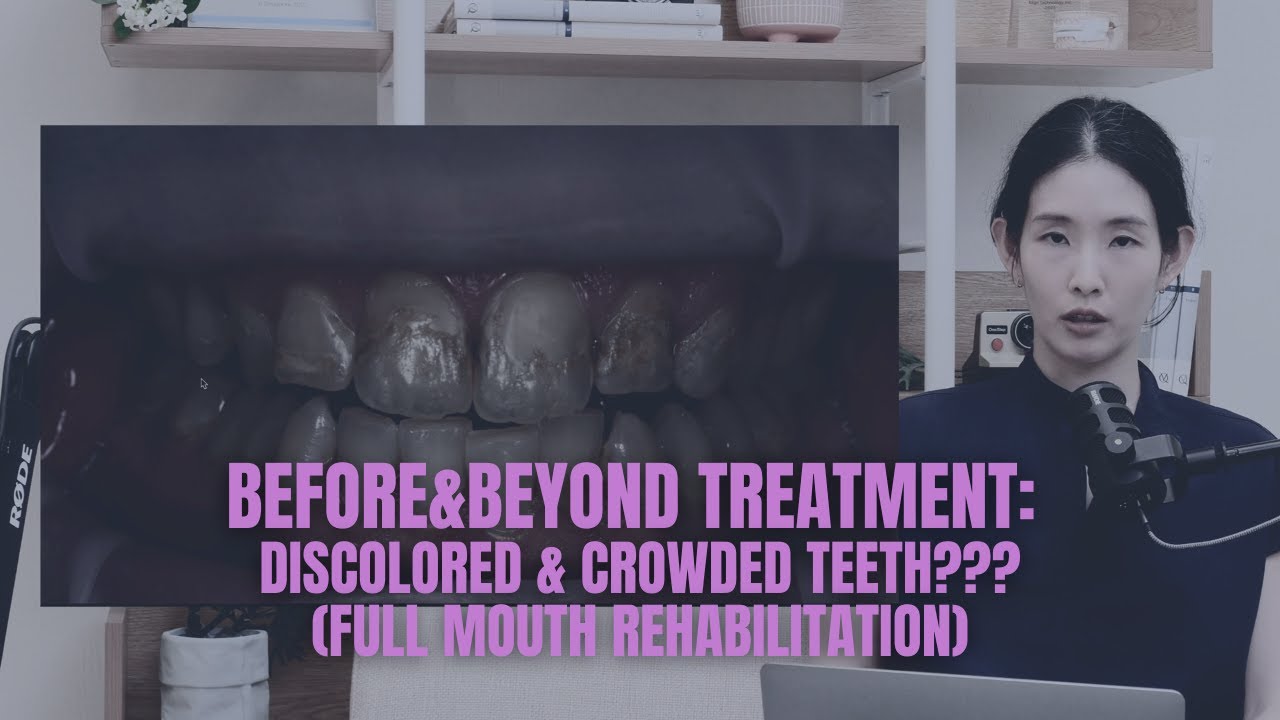 Discoloured & Crowded Teeth? How We Fix Them (FULL MOUTH REHABILITATION)| BEFORE & BEYOND EP48