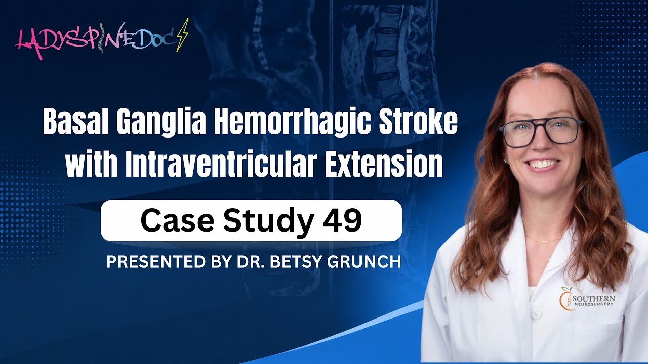 Case study 49 - Basal Ganglia Hemorrhagic Stroke with Intraventricular Extension