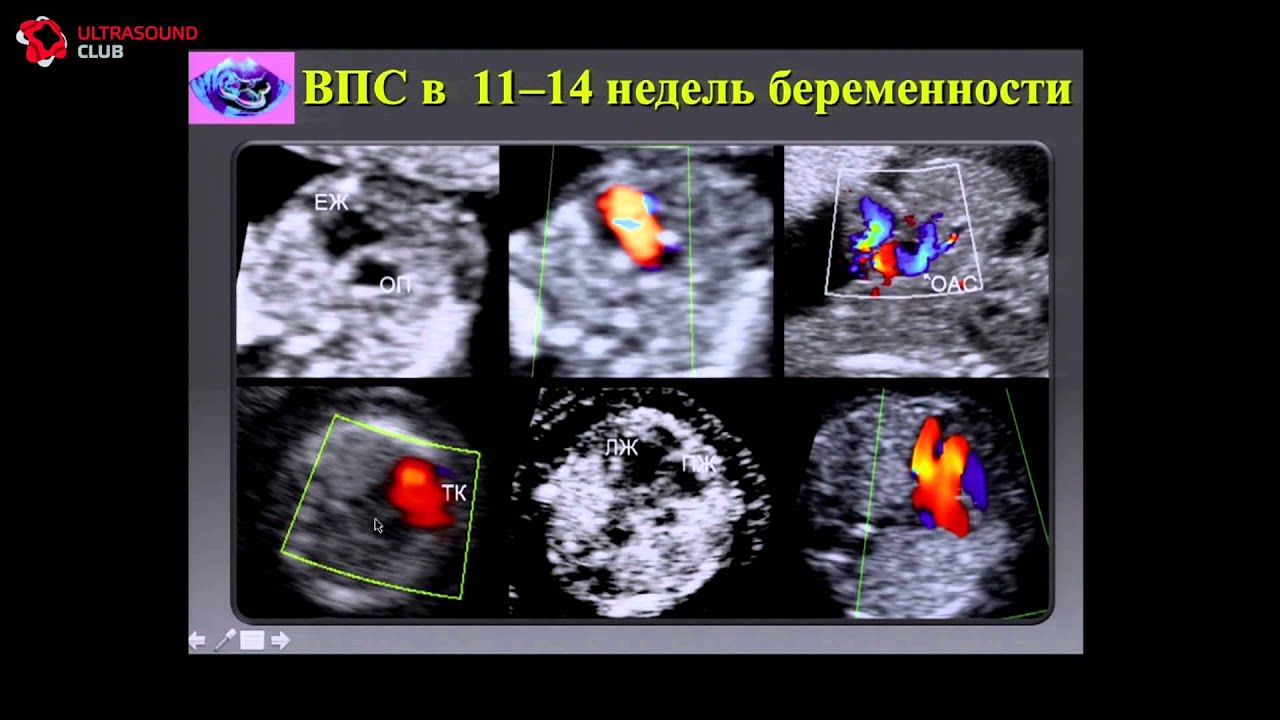 Пренатальная диагностика врожденных пороков сердца в 11--14 недель беременности - М.В. Медведев