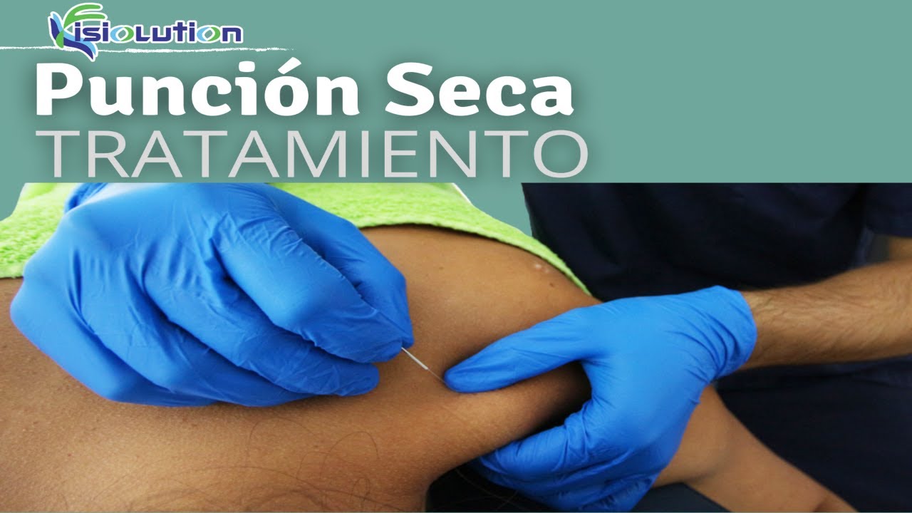 ¿Qué es la PUNCIÓN SECA? TRATAMIENTO para PUNTOS GATILLO | Fisiolution