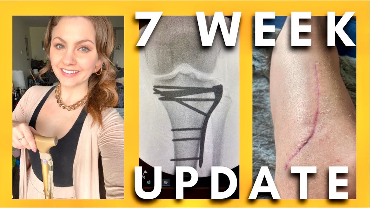 Walking Again After Knee Surgery | 7 Week Update