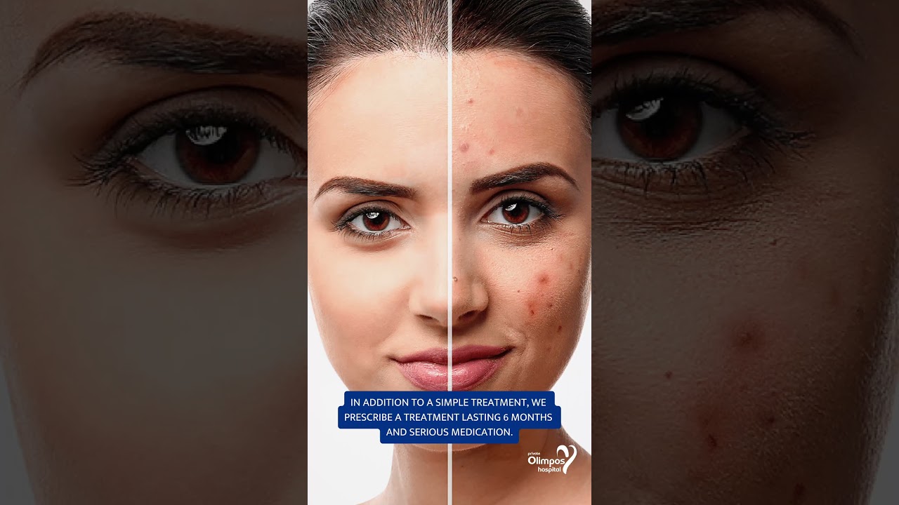 Akne nedir ve tedavisi nasıl yapılır? Dermatoloji (Cildiye) Uzmanı Dr. Ziya Köylüoğlu anlatıyor.