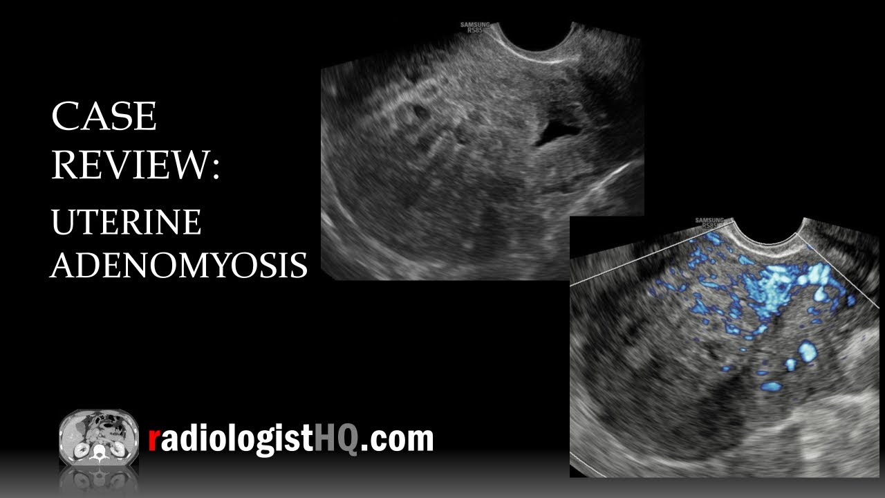Case Review: Ultrasound of Uterine Adenomyosis