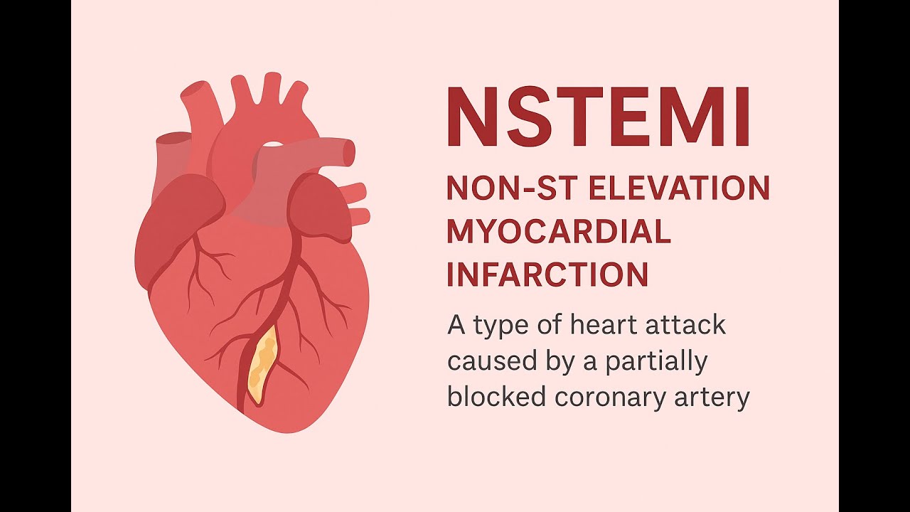 Non ST elevation myocardial infarction - NSTEMI-#NSTEMI &bull; #NonSTEMI &bull; #AcuteCoronarySyndrome &bull;