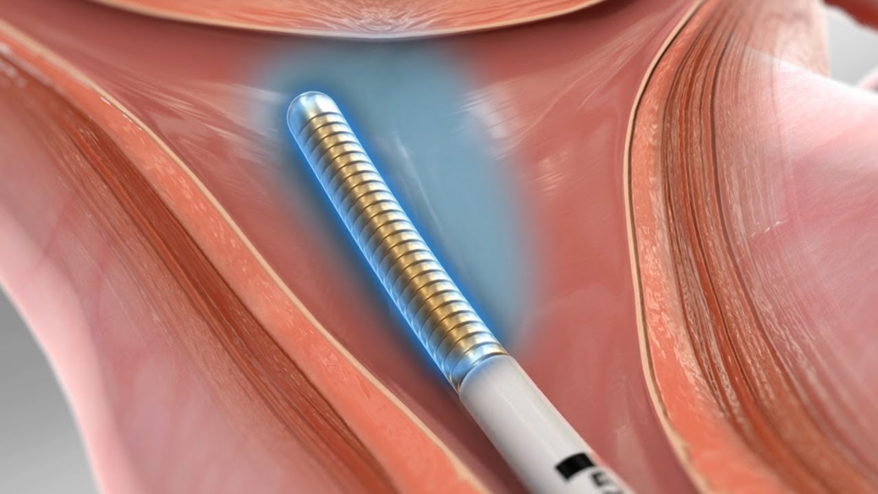 Ablaci&oacute;n Endometrial (m&eacute;todo de crioablaci&oacute;n)