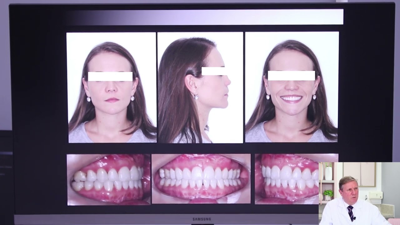 Rinoplastia ou Ortognática, qual procedimento devo realizar primeiro | Dr. João Luiz Carlini