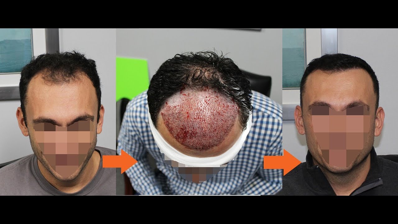WATCH: Hair Transplant Patient's Journey from Day 0 to Month 6! | Feller & Bloxham | NY, NYC, NJ