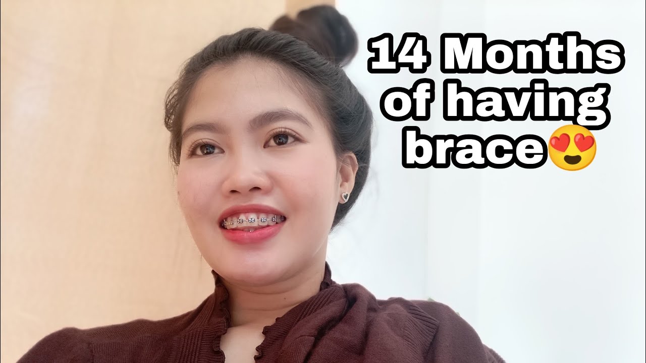 Braces Update : 14 Months of Wearing Braces | Adjustment 😍