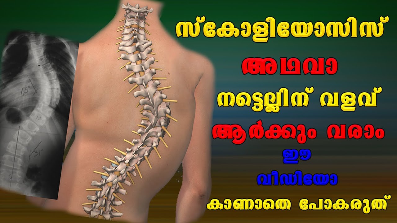 സ്കോളിയോസിസ് അഥവാ നട്ടെല്ലിനു വളവ് ആര്‍ക്കും വരാം നിങ്ങള്‍ അറിയേണ്ടത് ./Baiju's Vlogs