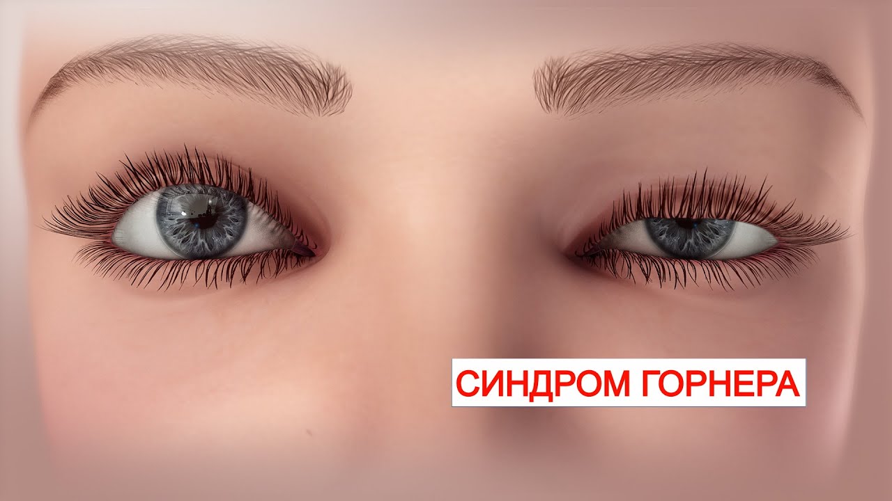 👁Синдром Горнера (Окулосимпатический Синдром)