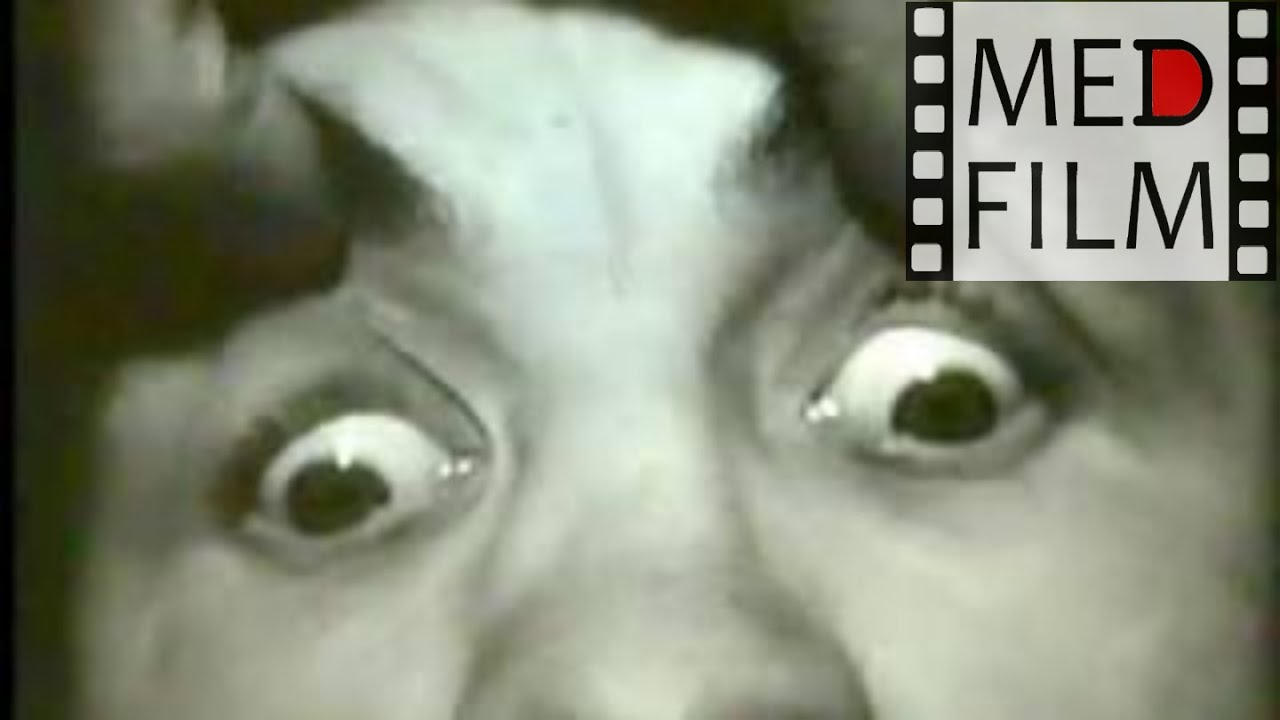Поражение глазодвигательного и отводящего нервов © The defeat of the oculomotor and abducens