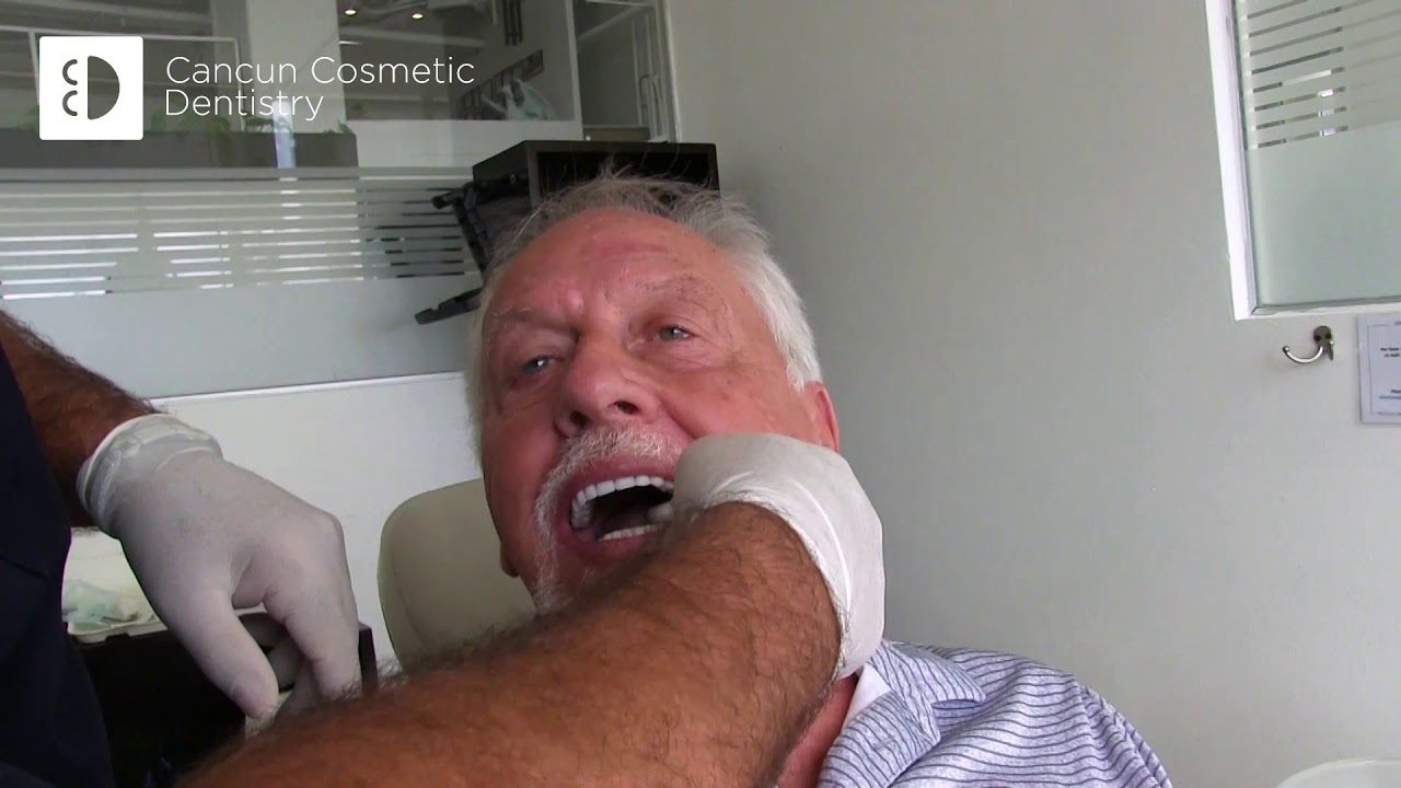Wayne tries his new Snap in Dentures! 😁 Check this Snap in Dentures Mexico Reviews