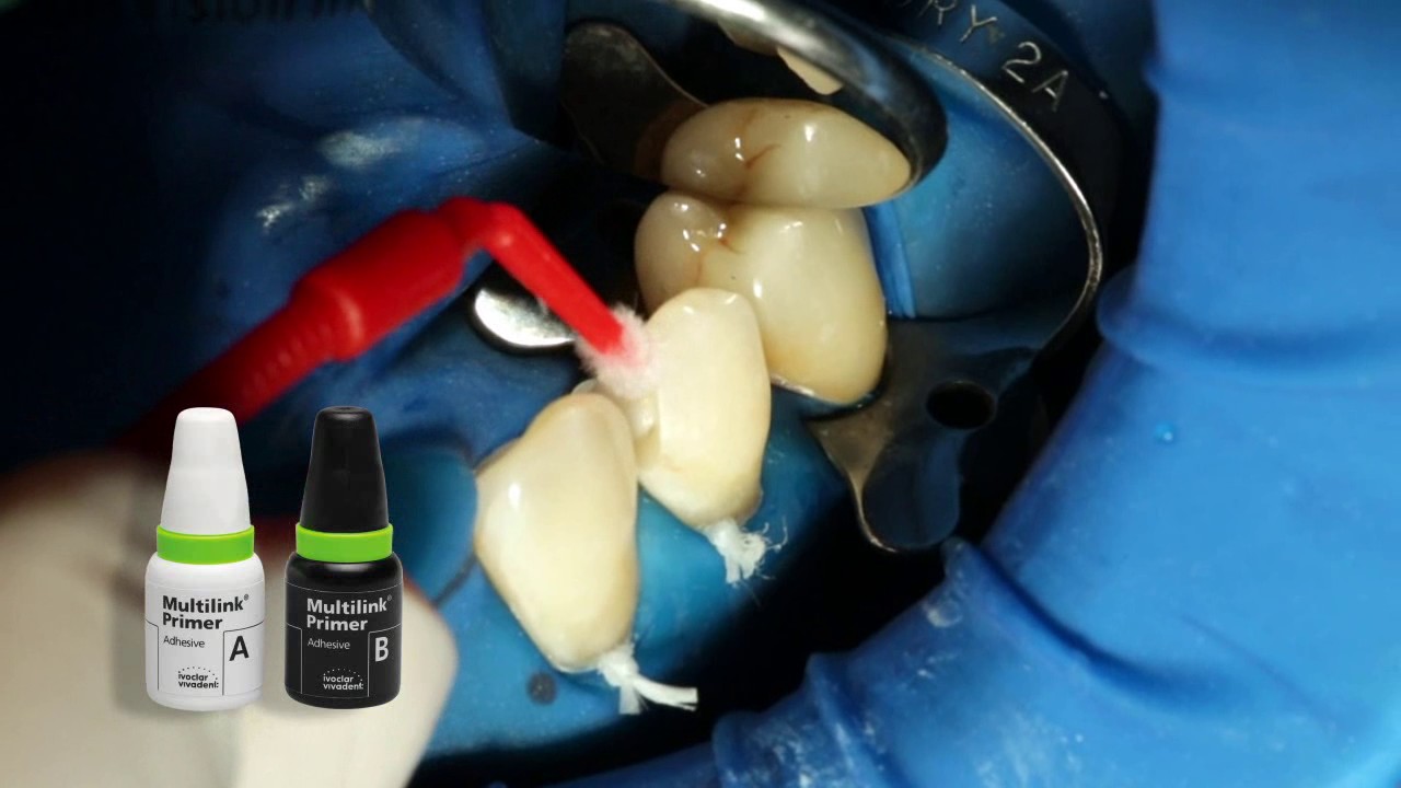 Multilink Automix IVOCLAR VIVADENT
