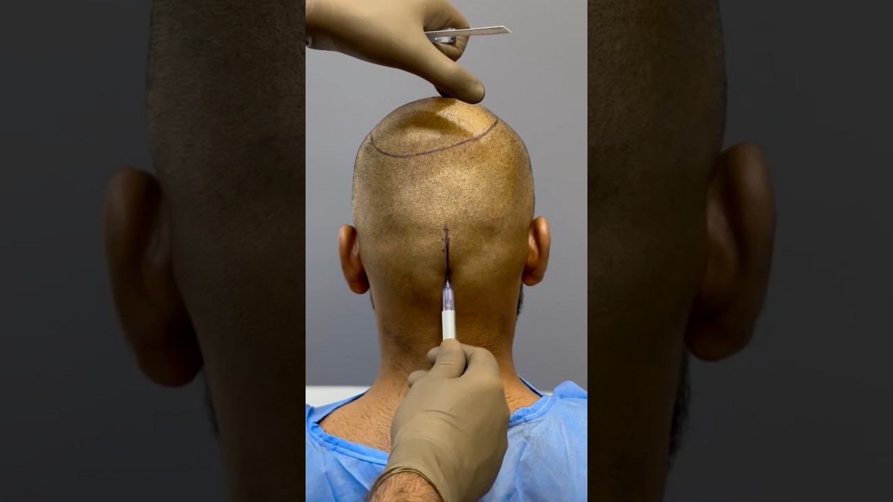 MIND-BLOWING Hair Transplant Surgery | Latest Fue Technique #shorts #viral #hair